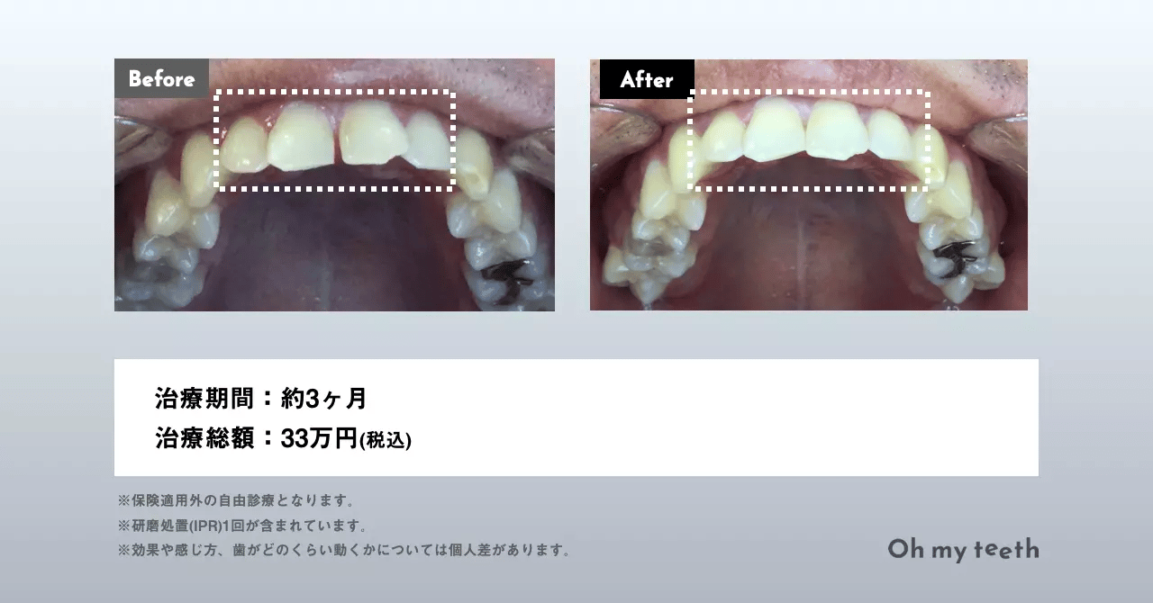 歯科矯正していると就活で不利？就職と歯並びとの関係