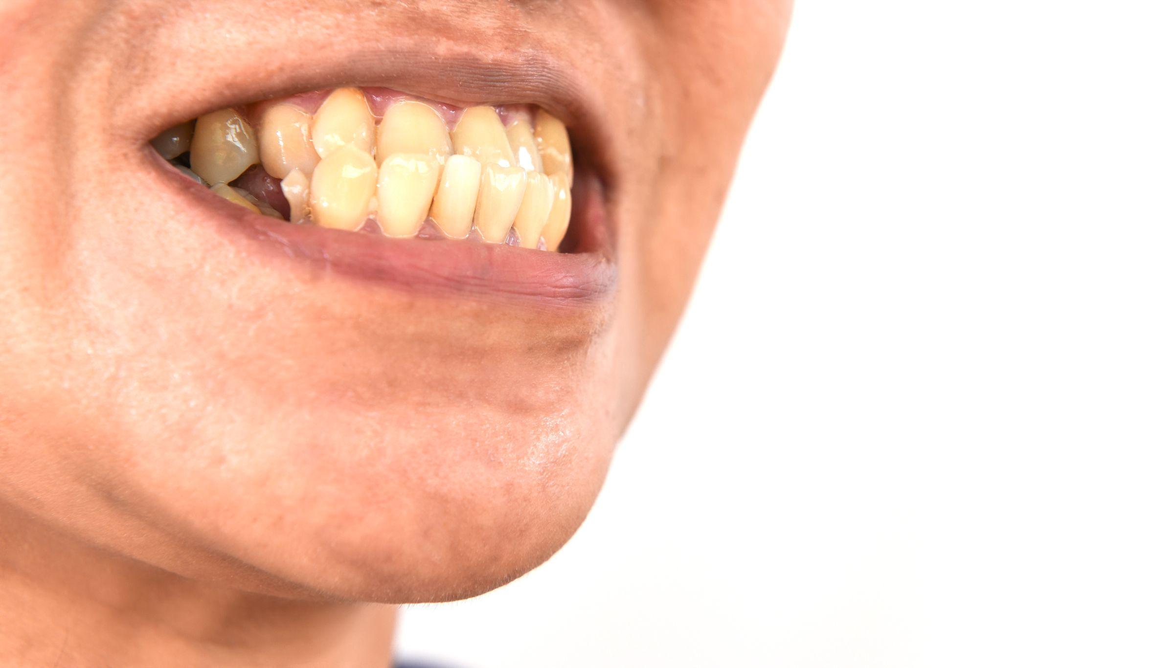 下顎の歯が上顎の歯よりも前に出ている様子