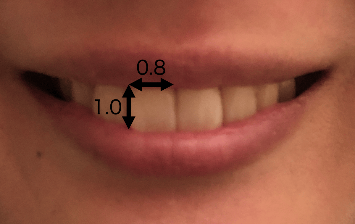 理想的なスマイルラインとは？矯正治療で改善できるのか解説