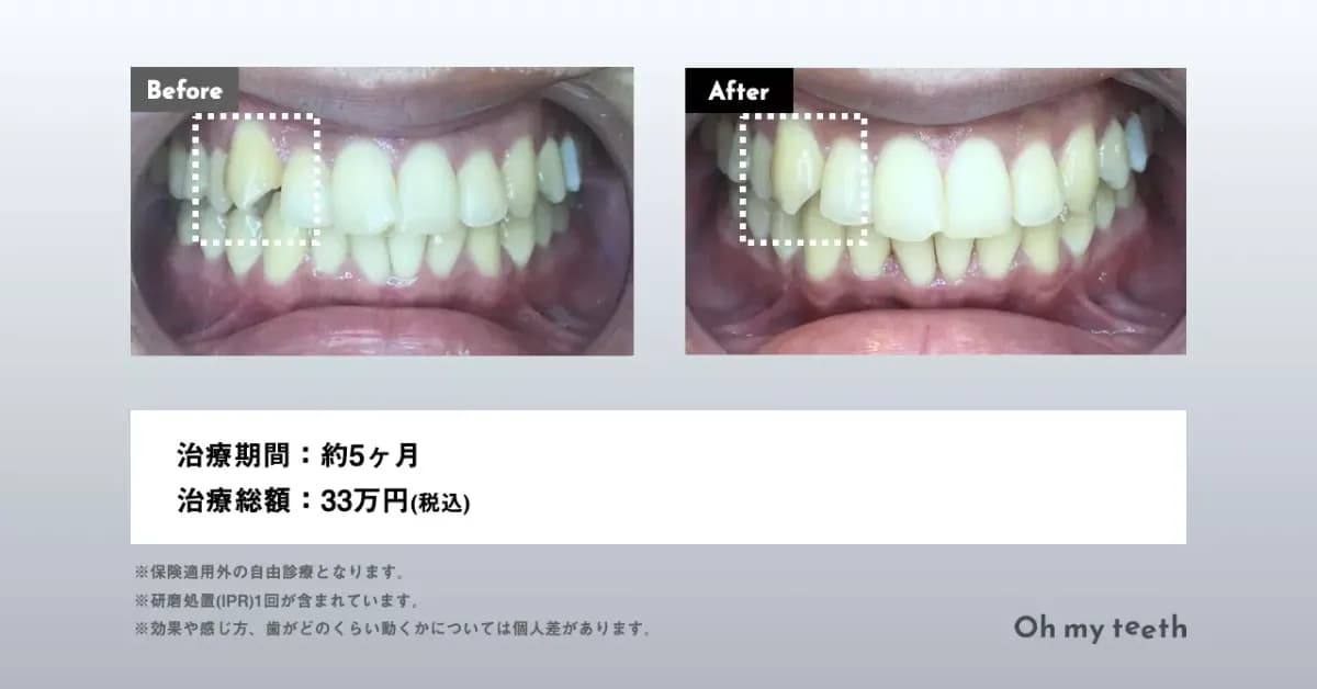Oh my teethマウスピース矯正の症例画像(八重歯)