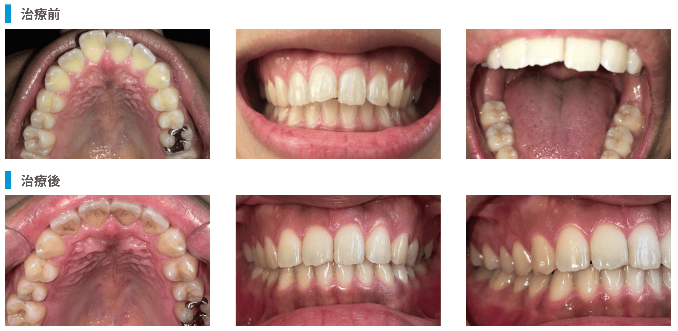 マウスピース矯正 hanaraviの前歯部の叢生(ガタつき)の症例