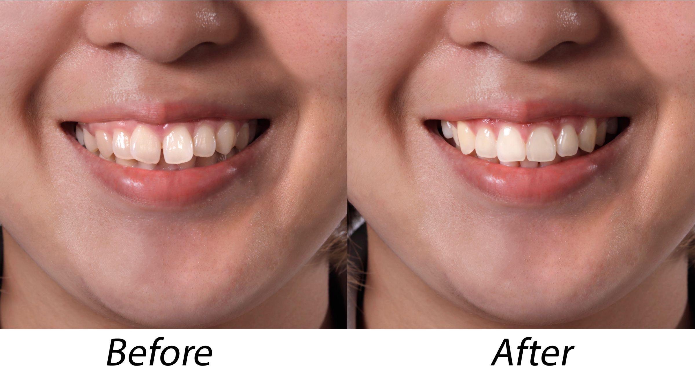 歯科矯正のビフォーアフター写真のようにきれいな歯並びになる方法