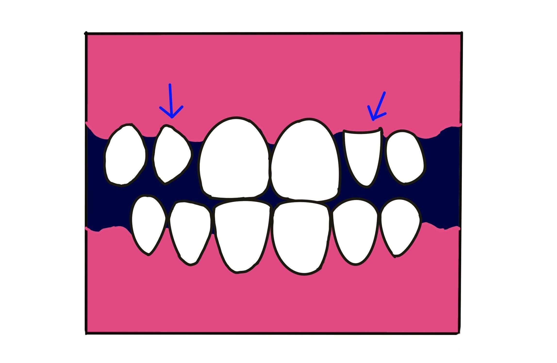歯が小さいのを大きくできる？原因や治し方を解説