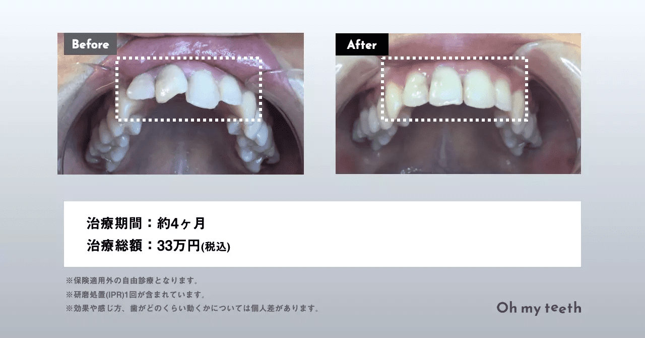 マウスピース矯正 Oh my teethの症例(上前歯ねじれ)