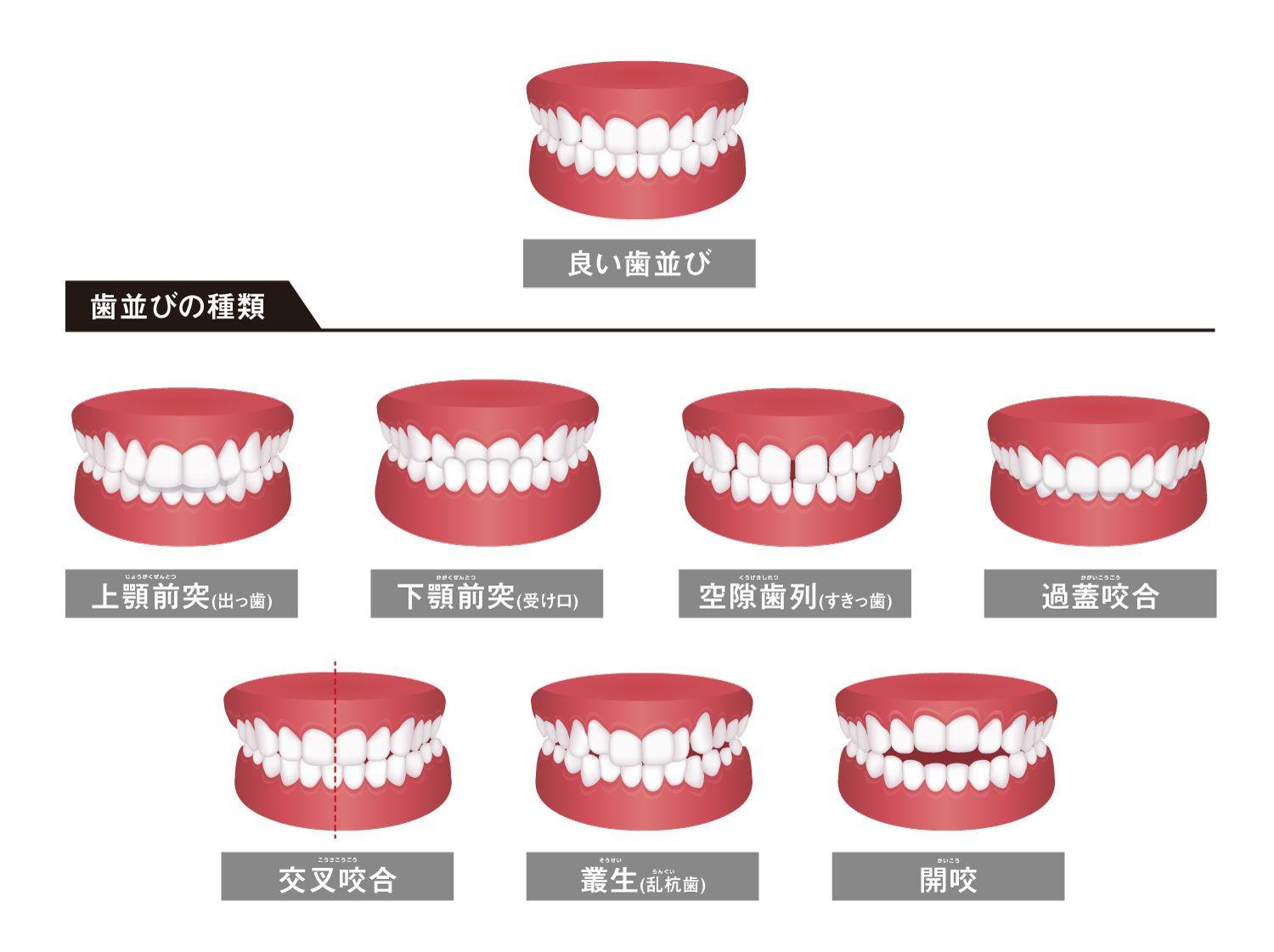 千鳥 ノブさんが歯科矯正を開始！「下の歯が全員寝そべる」とはどんな状態？ 