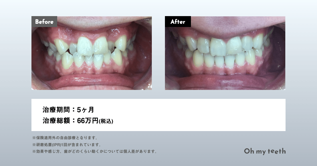 マウスピース矯正 Oh my teethの八重歯の症例(全体矯正)