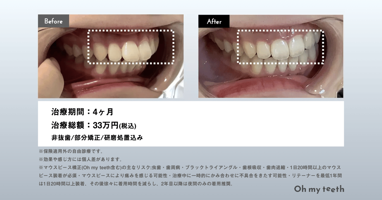 Oh my teeth 症例 (出っ歯・女性・大学2年生)