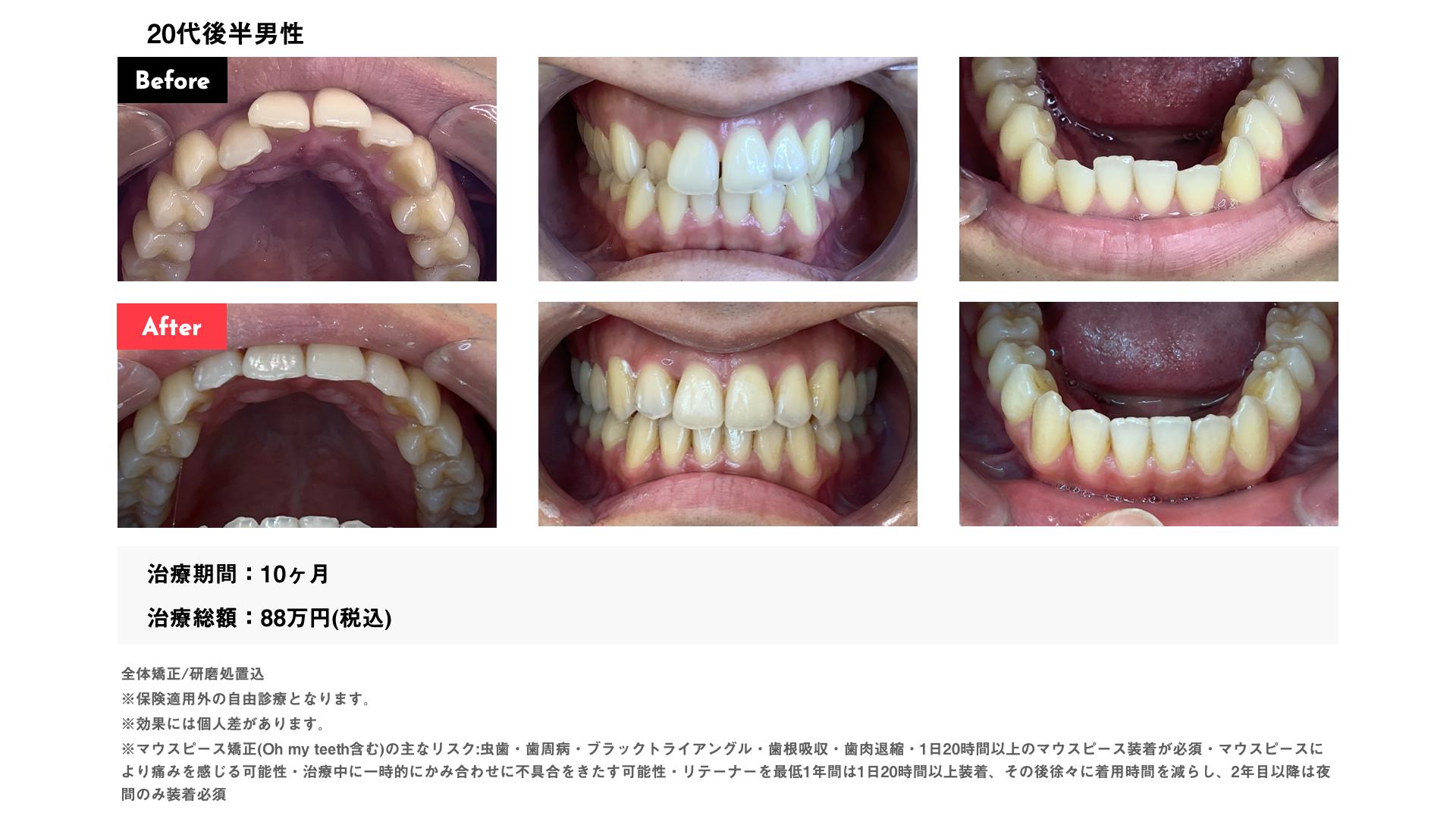 インビザライン10カ月・88万円・20代後半男性 八重歯・叢生
