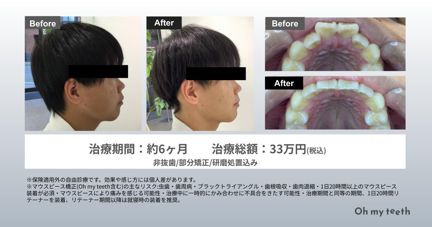 出っ歯治療で横顔は変わる!変化がわかる症例写真を紹介