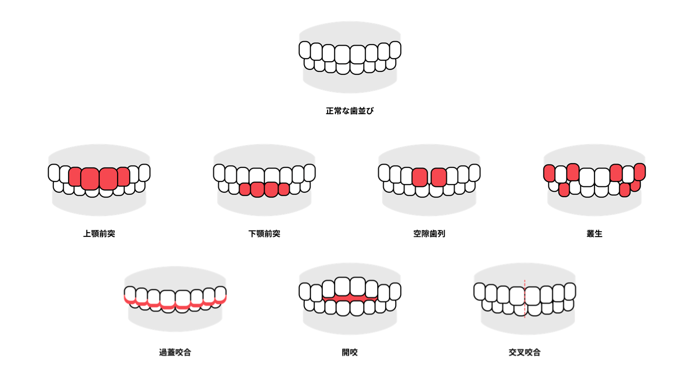 歯並び種類