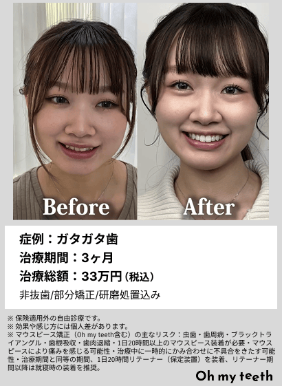 全顔BA・ガタガタ歯
