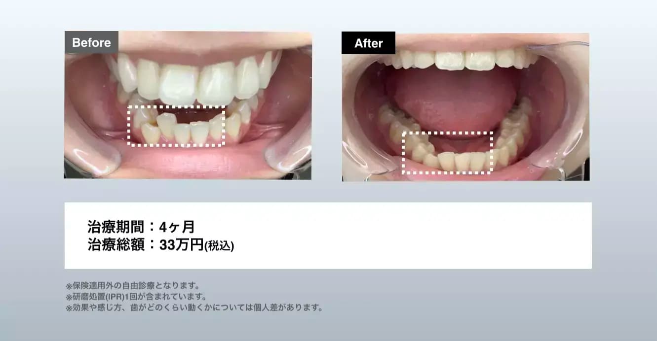 マウスピース矯正 Oh my teethのデコボコの歯並び(叢生)の症例(部分矯正・非抜歯)