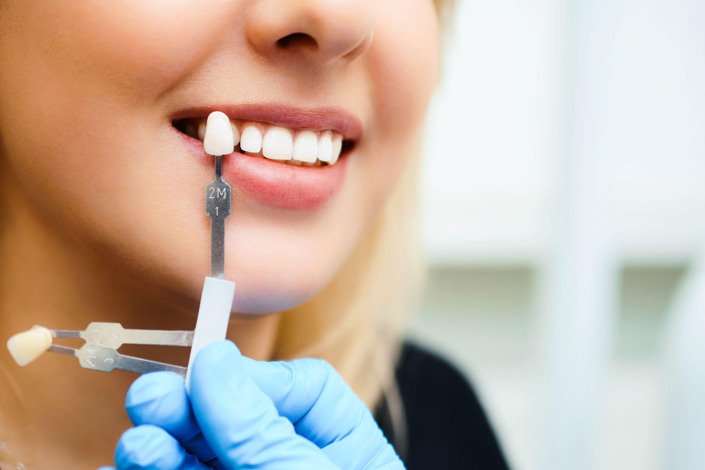 ホワイトニングは虫歯があってもできる？治療後に施術する際の注意点も解説