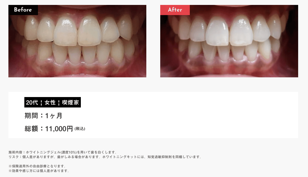 デュアルホワイトニングとは？効果からデメリットまで徹底解説