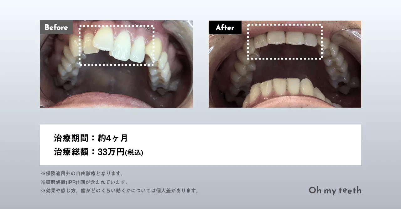 通わないマウスピース矯正 Oh my teethのメリット・デメリットを公式ブログ担当が徹底解説