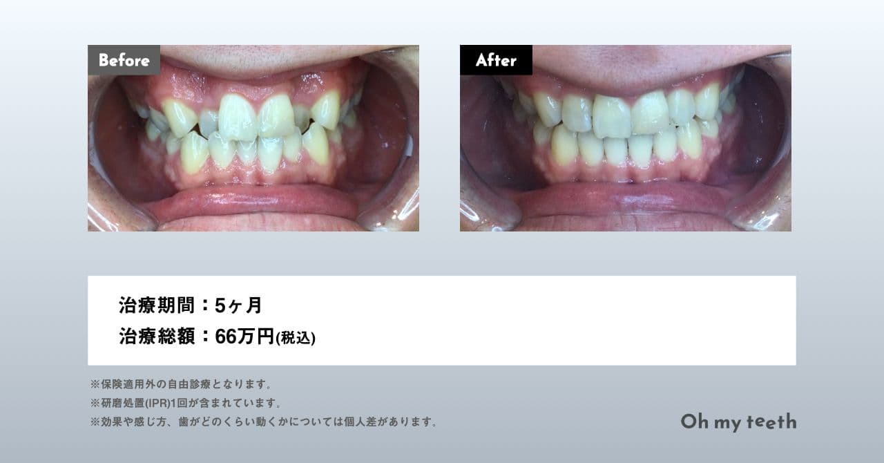 部分矯正と全体矯正の違いって？メリットデメリットも解説