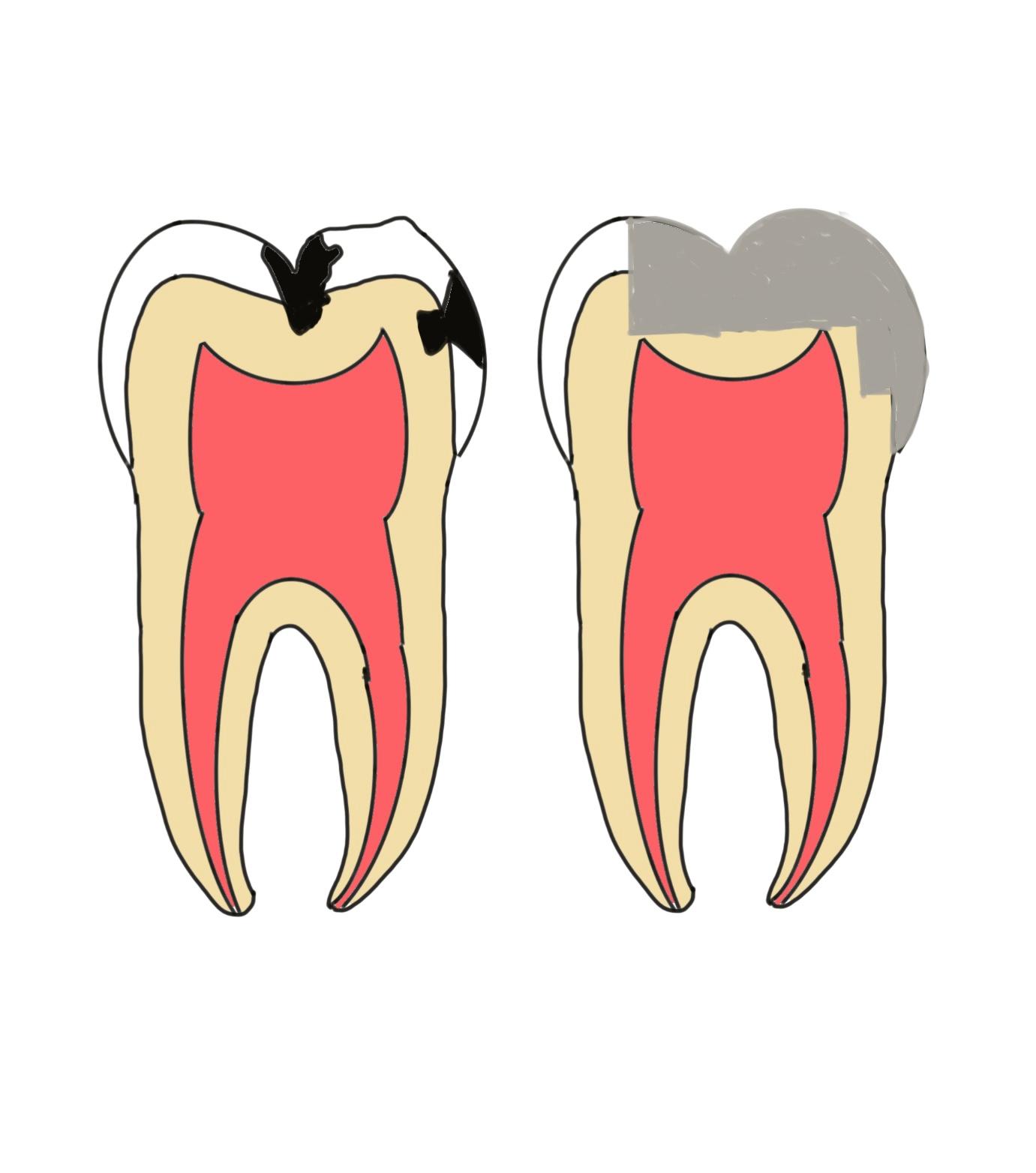 虫歯と治療後のイラスト
