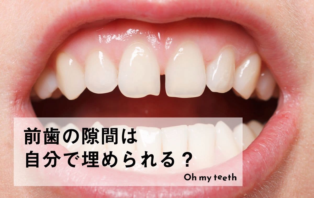 前歯の隙間は自分で埋められる？