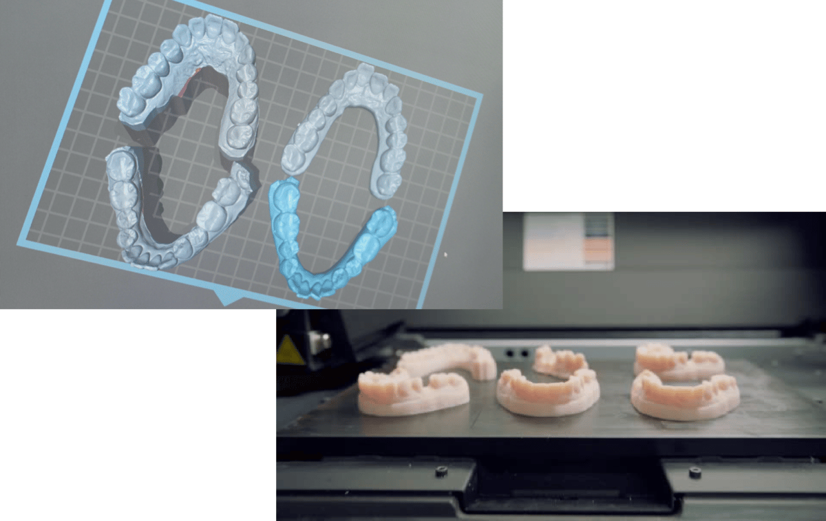 3Dプリンターソフトと3Dプリントにより作製された歯型