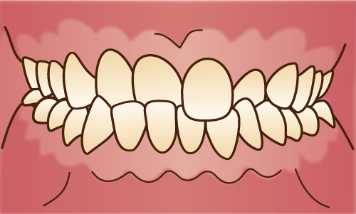 歯並びが悪くなる原因と種類・治療方法を解説  