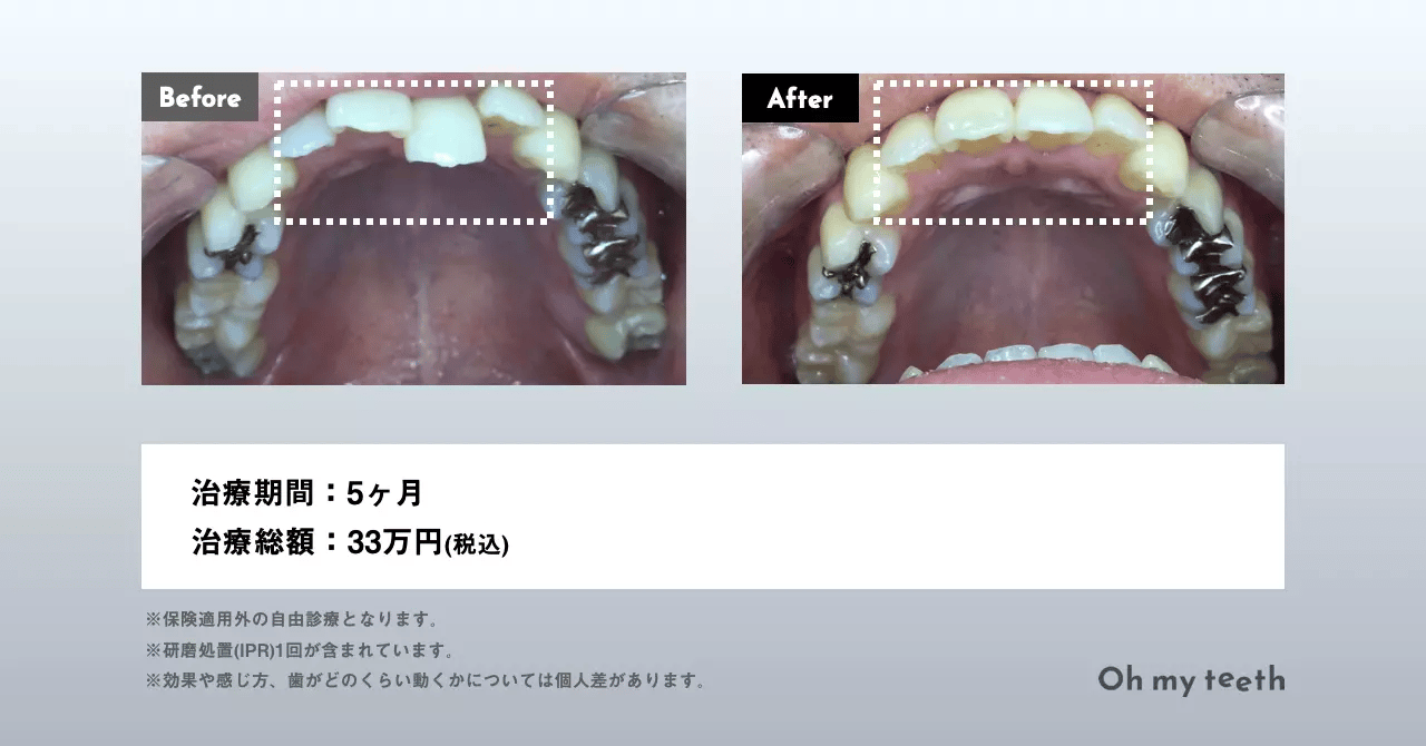 マウスピース矯正「Oh my teeth」部分矯正プランの症例