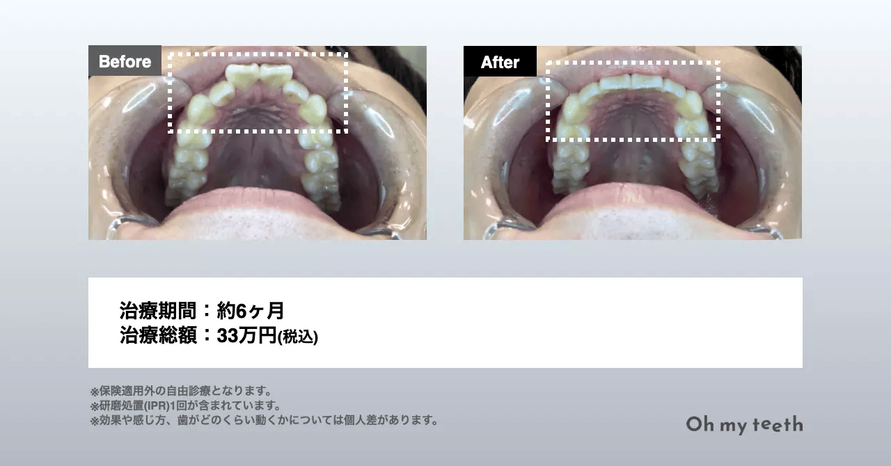 【原因別】出っ歯の治療方法!自力で治せるかも解説