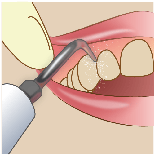 歯周病でも矯正できる？矯正中の歯周病予防法3つ