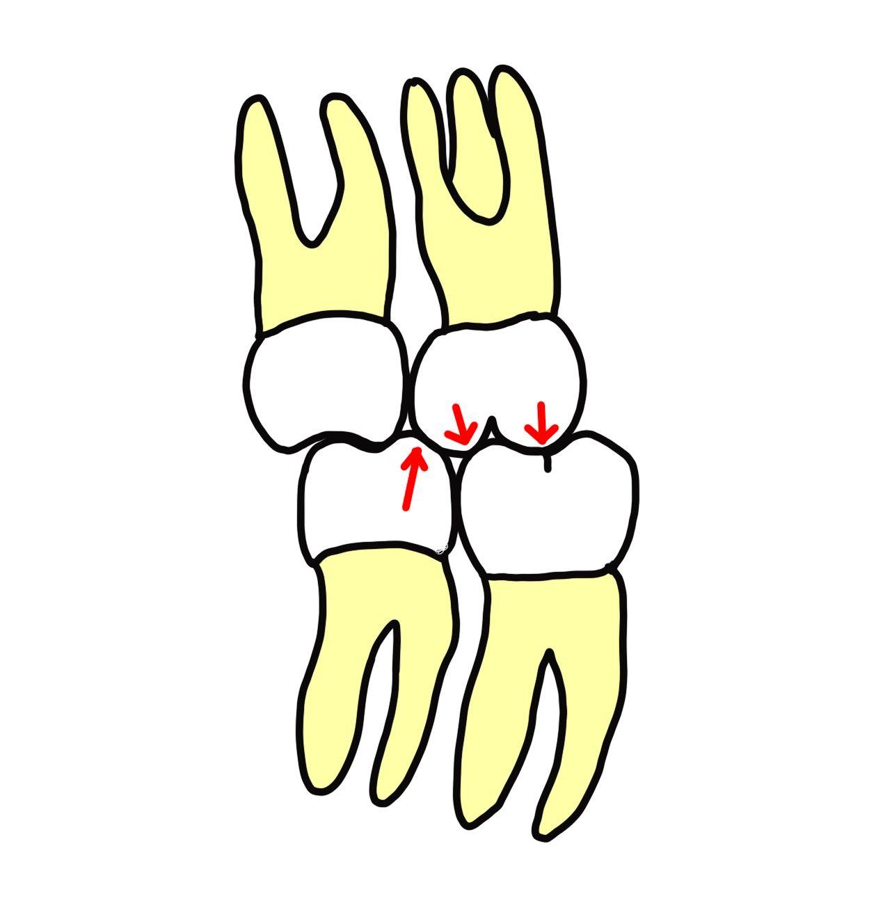 1歯対2歯での咬合関係