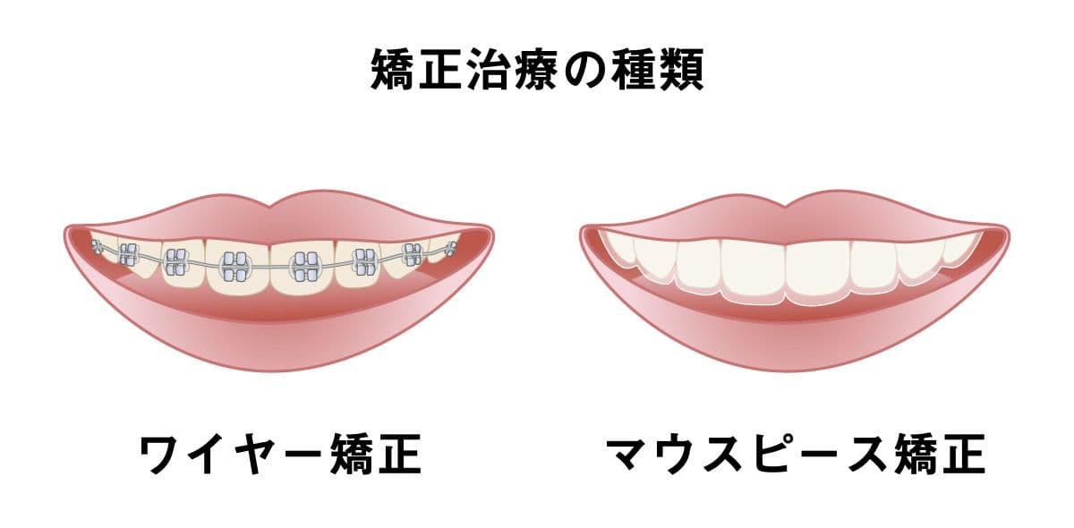 矯正治療の種類