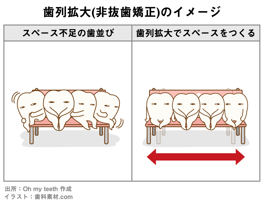 歯列拡大(非抜歯矯正)のイメージ