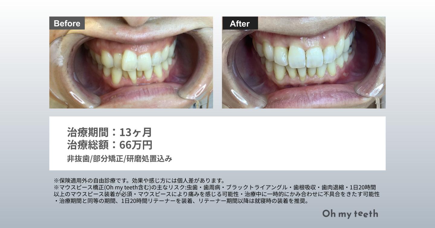 正しい嚙み合わせ 症例写真データ（ガタガタ13ヶ月プロ）