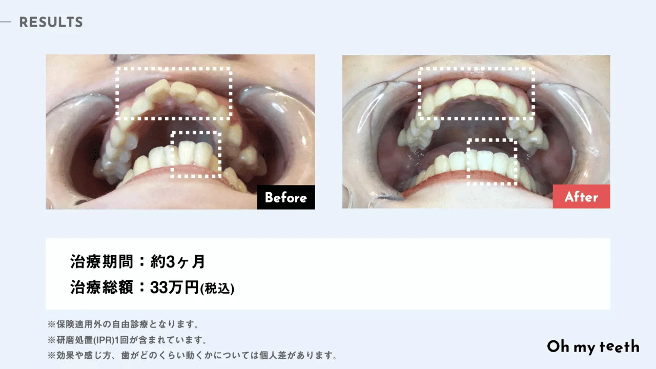 通わないマウスピース矯正 Oh my teethのメリット・デメリットを公式ブログ担当が徹底解説