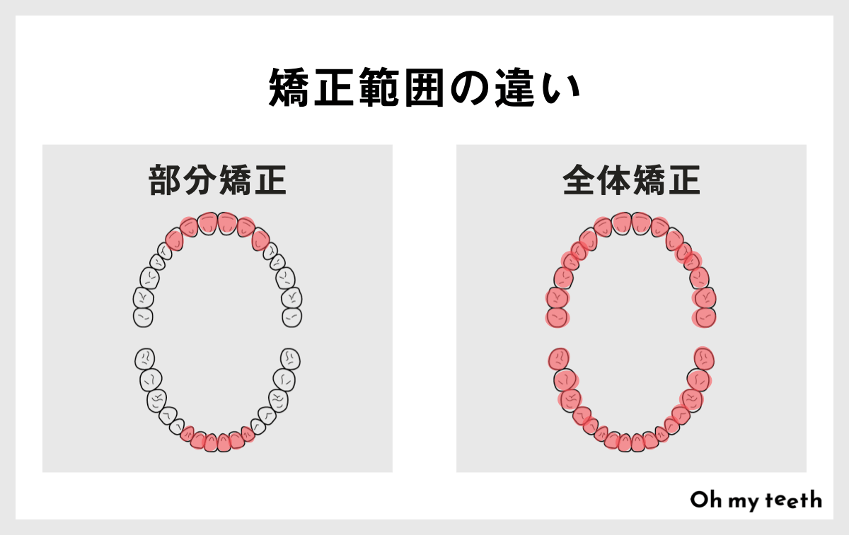 部分矯正と全体矯正の矯正範囲の違い