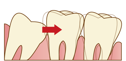 昔よりも前歯が出てきたのはなぜ？原因や治す方法を解説