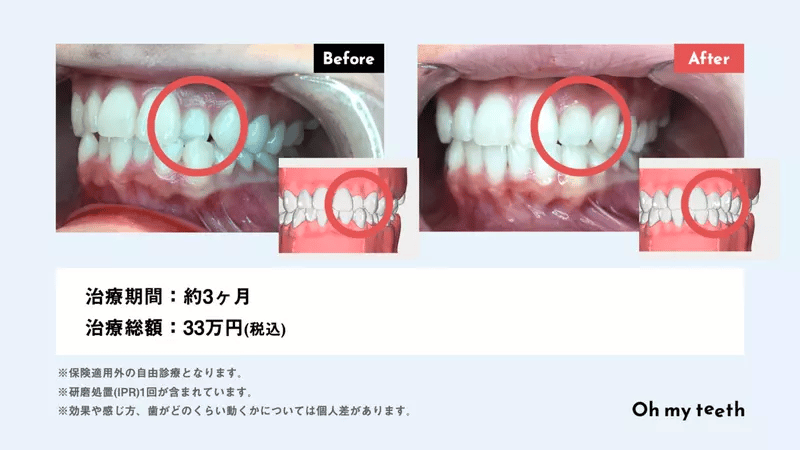 歯が小さいのを大きくできる?原因や治し方を解説