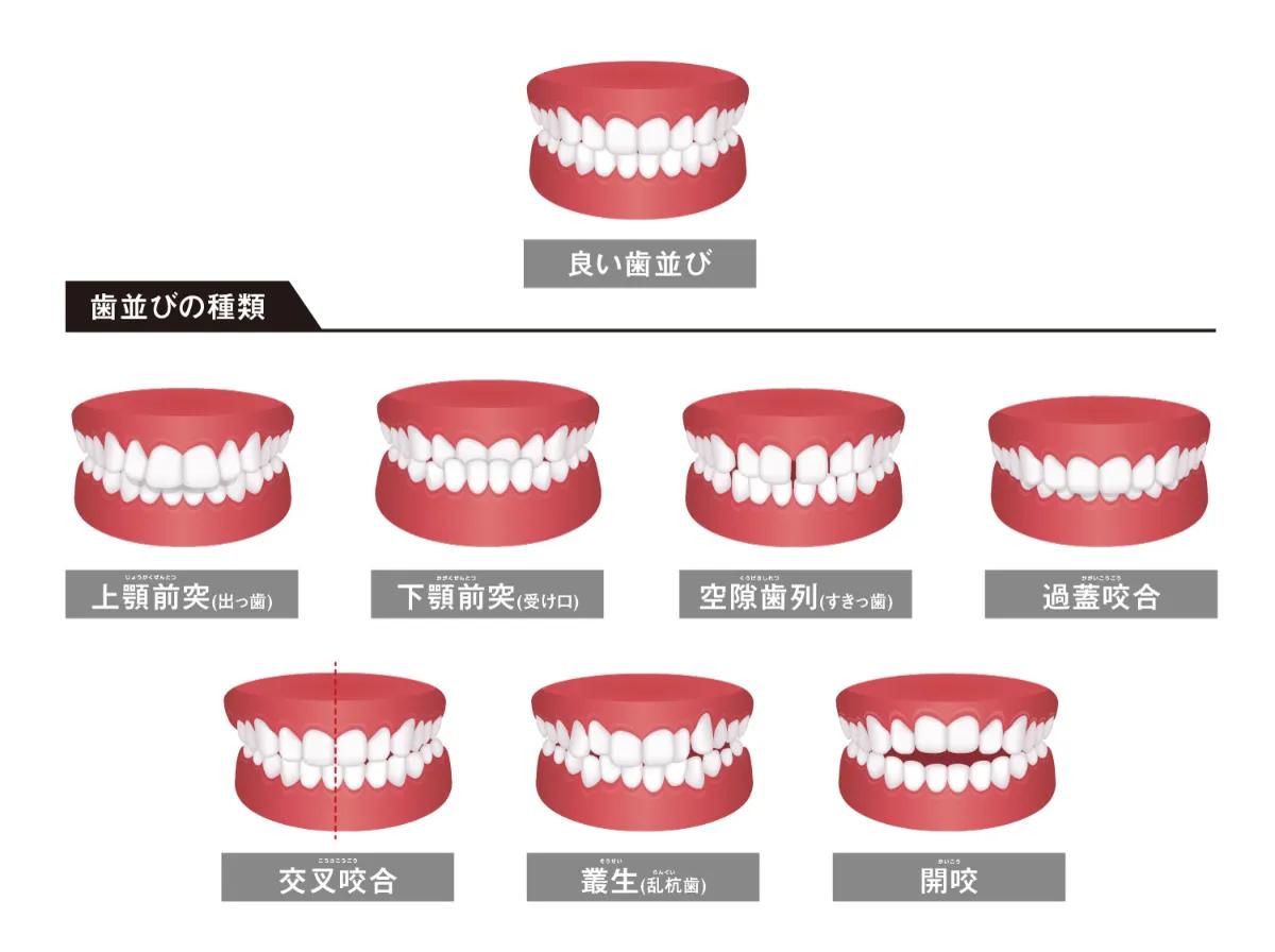 歯並びの種類のイラスト