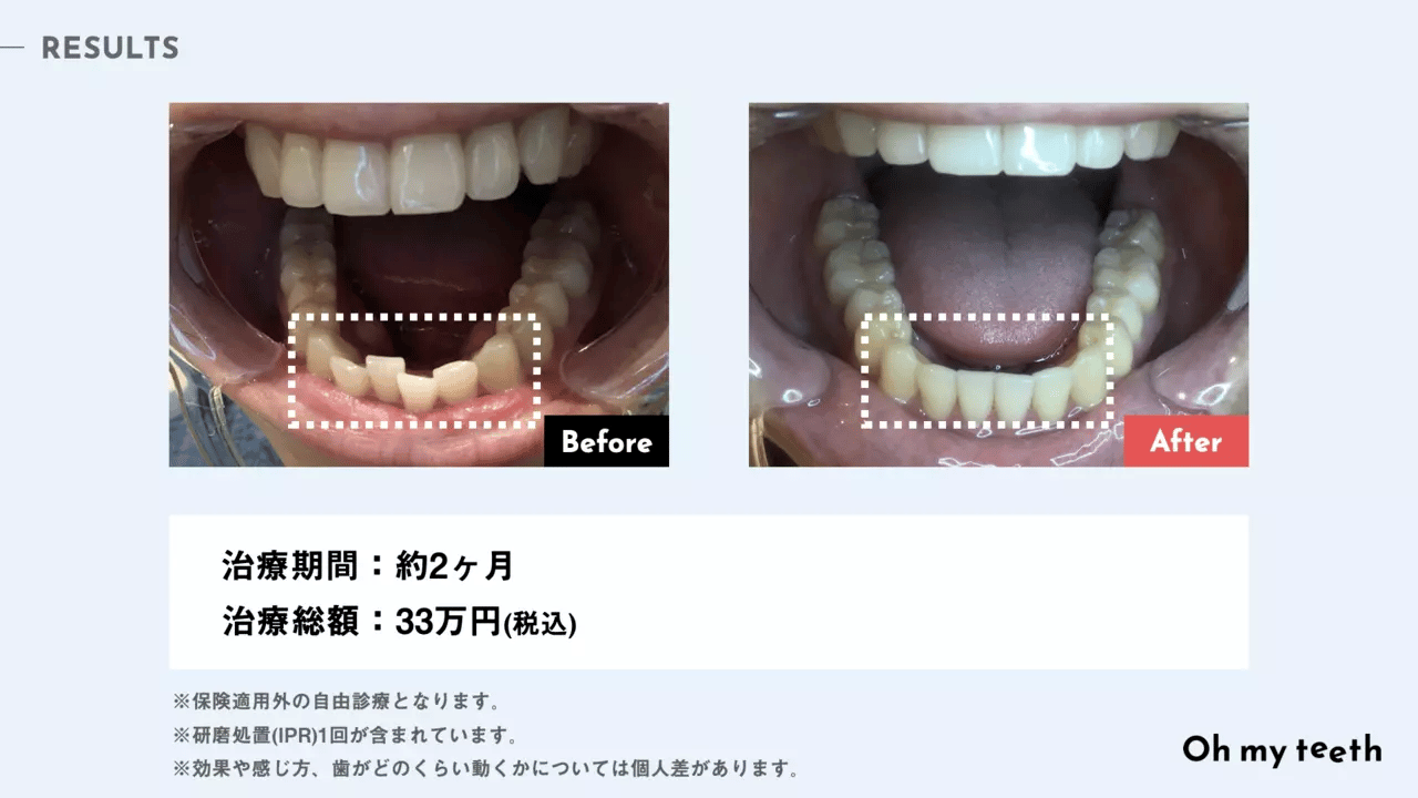 後戻りユーザーのマウスピース矯正 Oh my teethの症例(部分矯正)