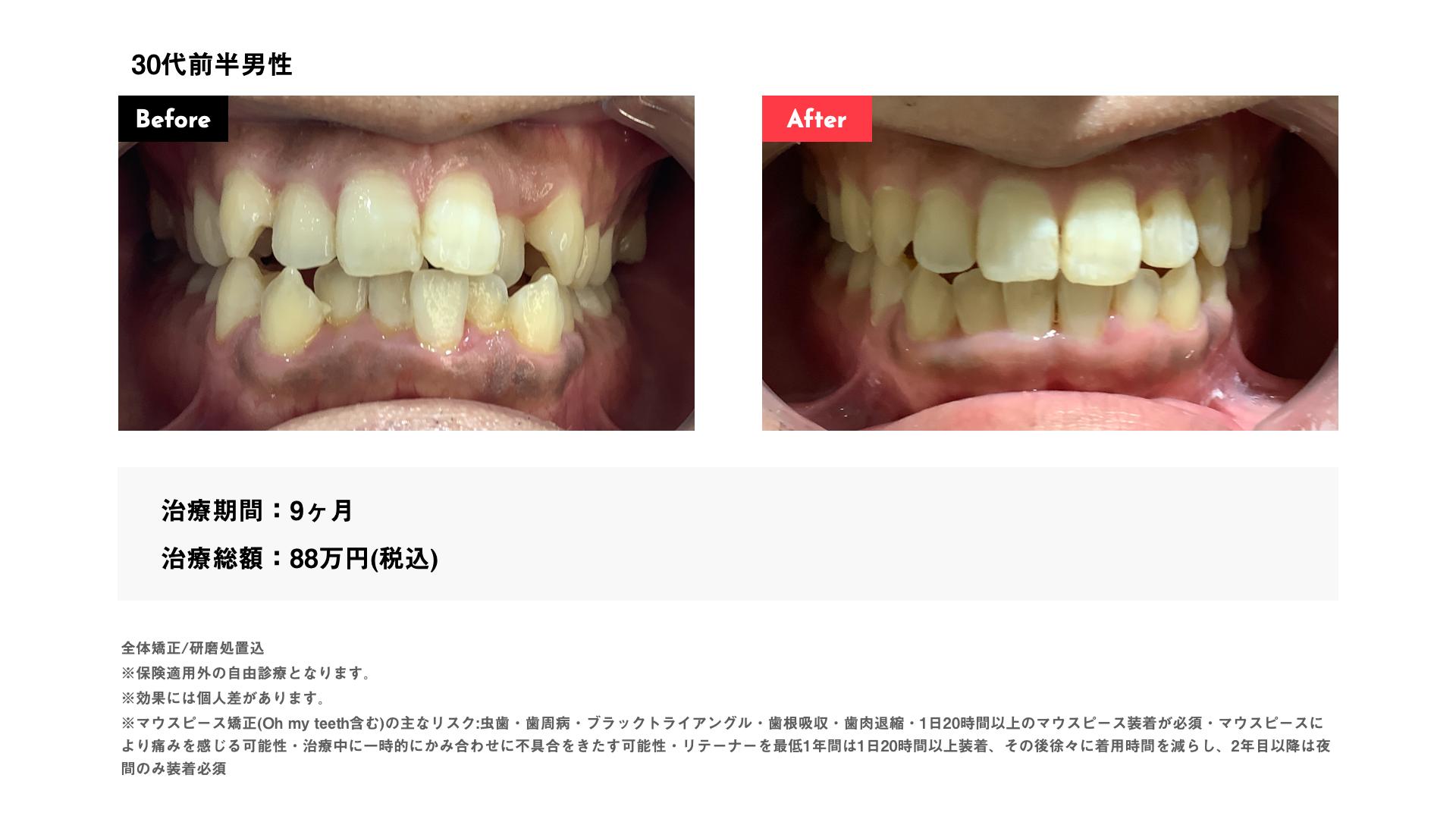 インビザライン9カ月・88万円・30代前半男性 八重歯・叢生