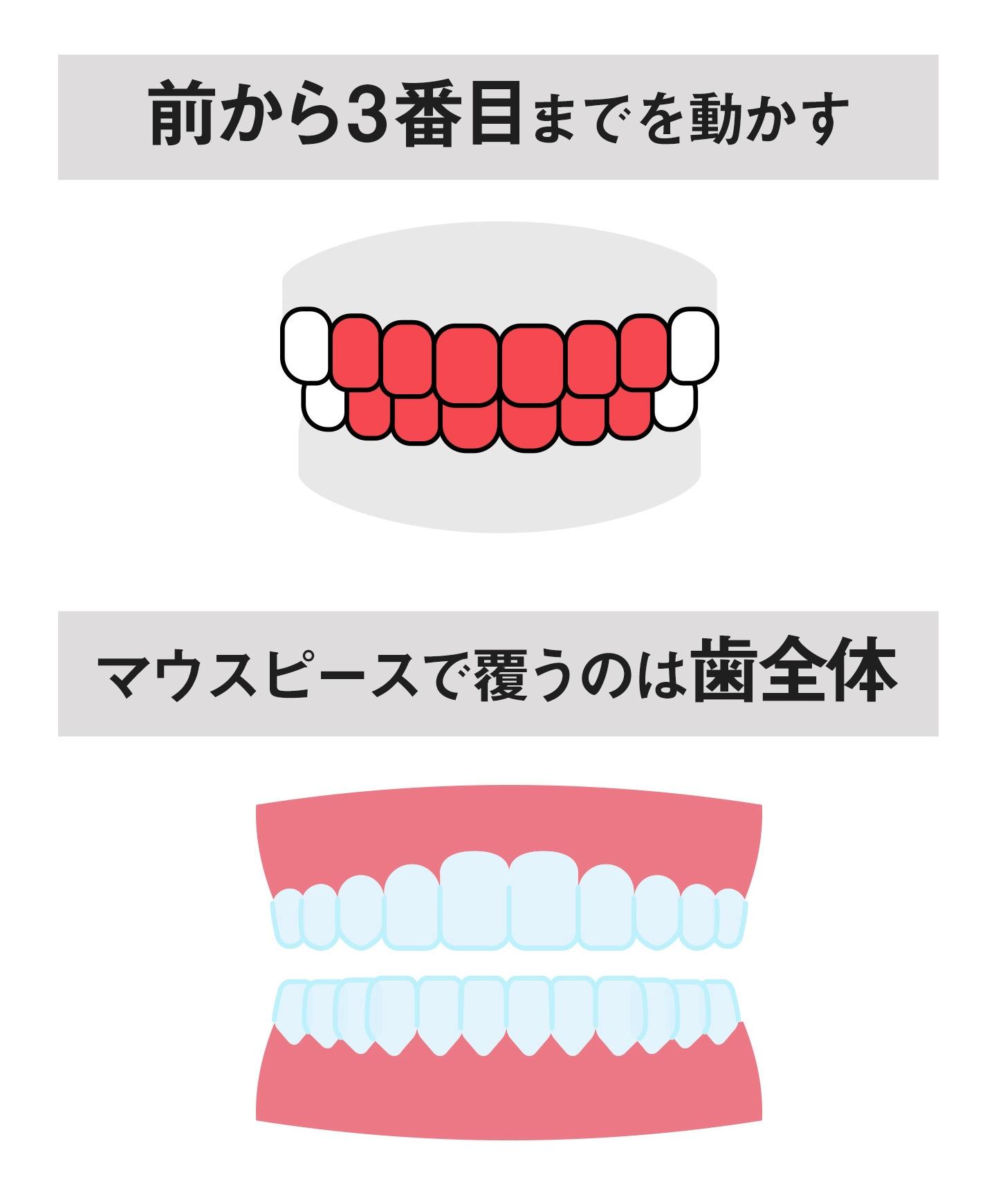 前歯だけのマウスピース矯正とは？