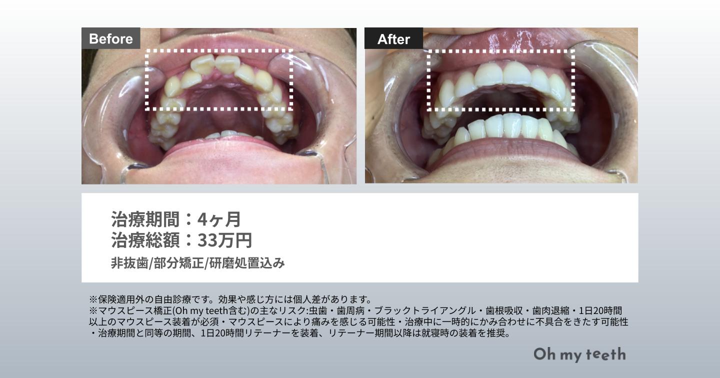 上の歯だけ矯正できる?できる症例や注意点をわかりやすく解説