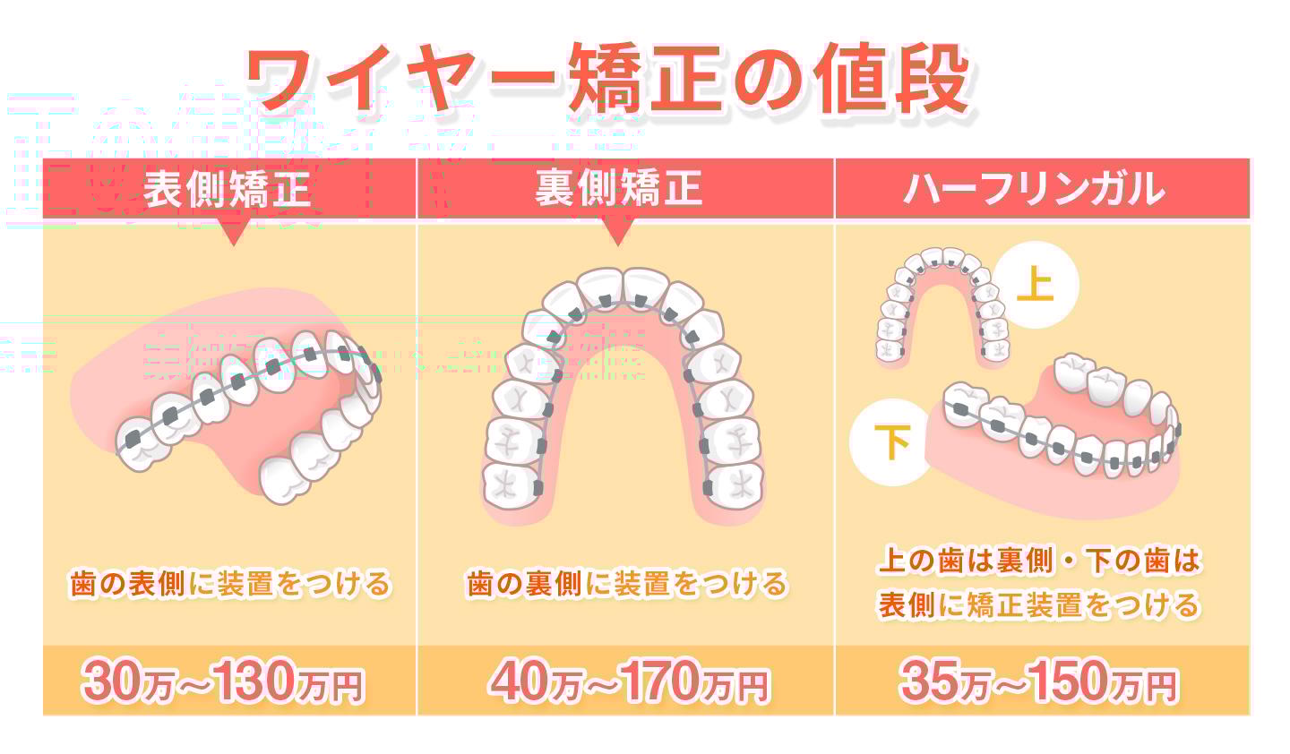 ワイヤー矯正の値段