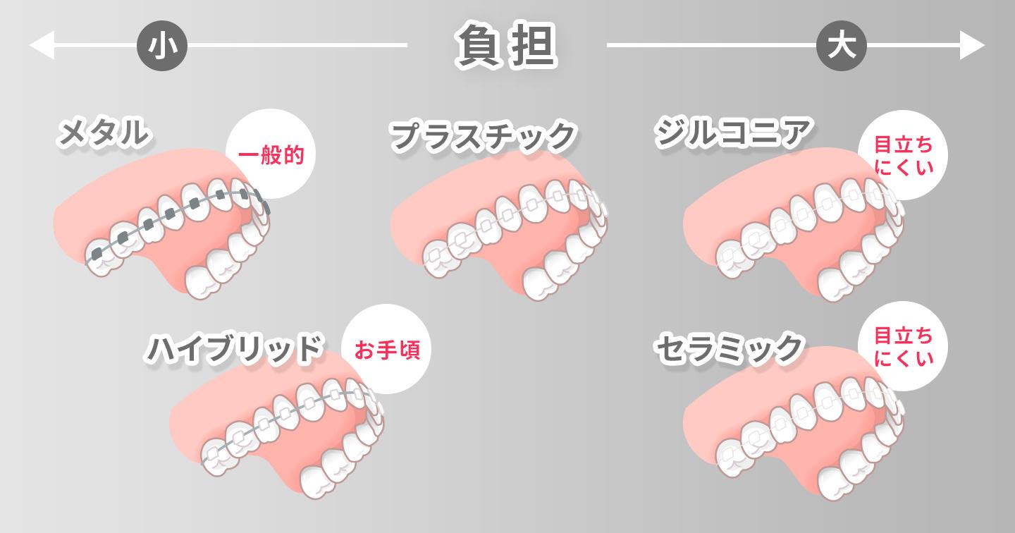 ワイヤー矯正装置の素材別の相場