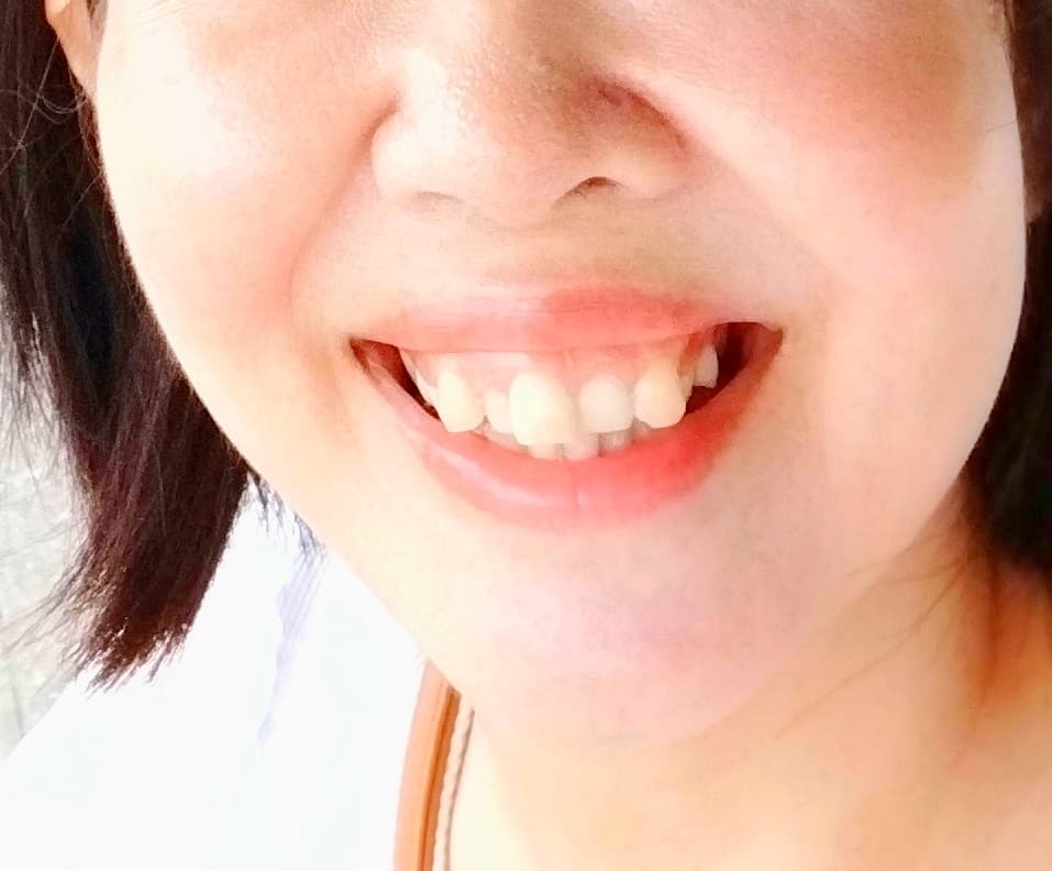 歯がガタガタで気になる!大人になってから治す方法はある?