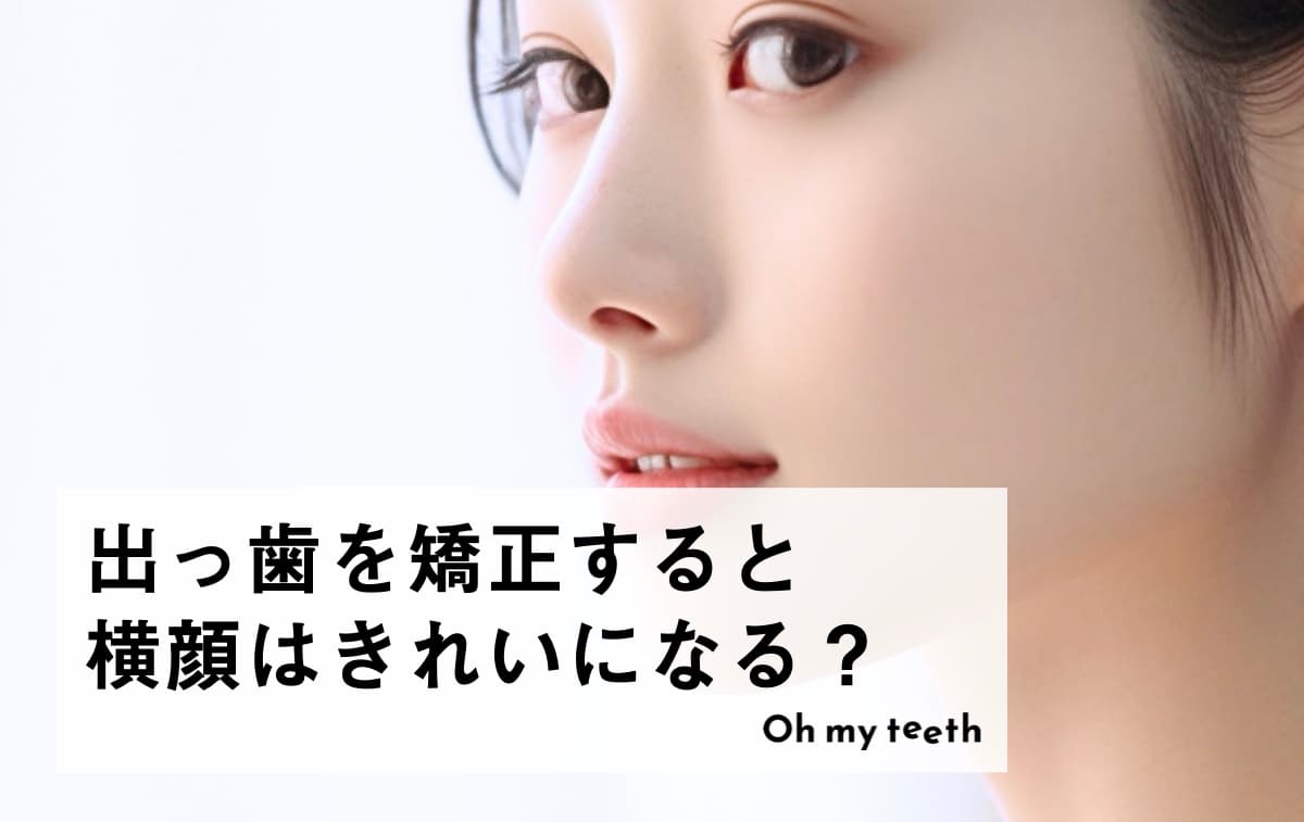 出っ歯を矯正すると横顔はきれいになる?