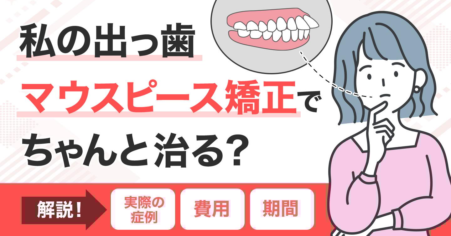 マウスピース 出っ歯