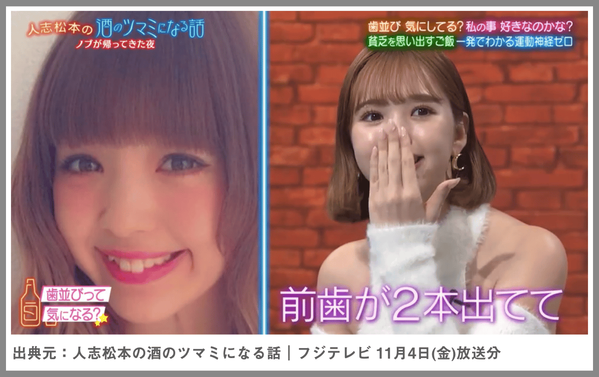 藤田ニコルさんは歯をセラミックで矯正!歯科矯正との違いも解説
