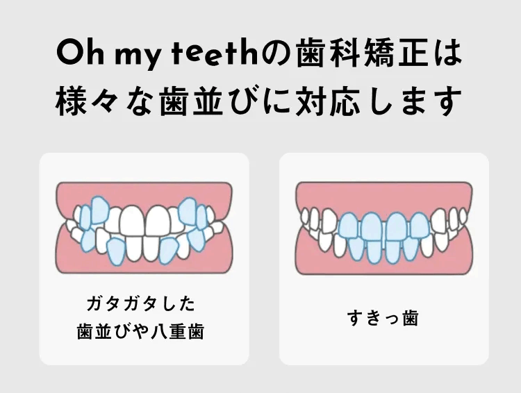 様々な歯並びに対応しますanimeGIF
